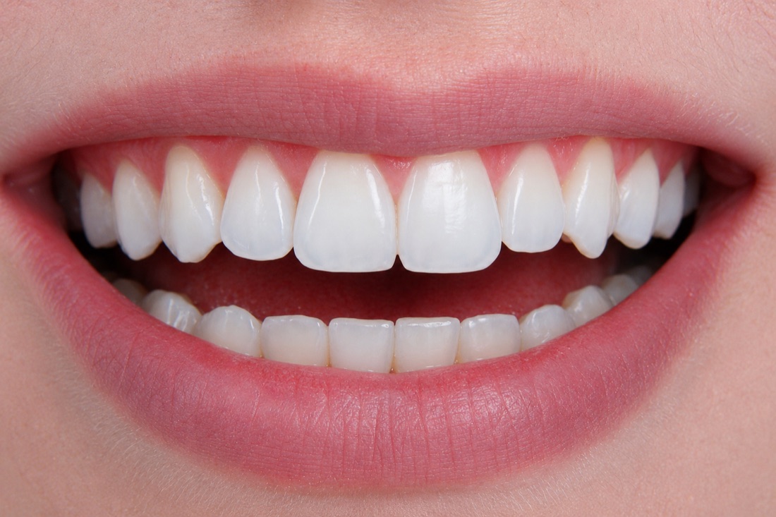 Sorriso com facetas — resultado natural