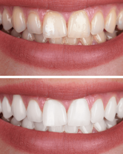 clareamento-dental
