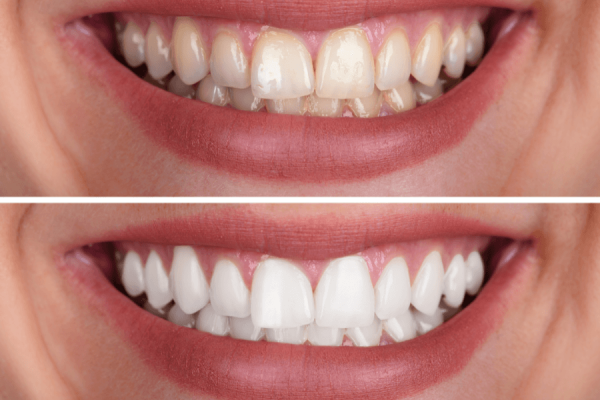 clareamento-dental